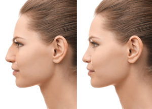 Best Nose Jobs South Bend