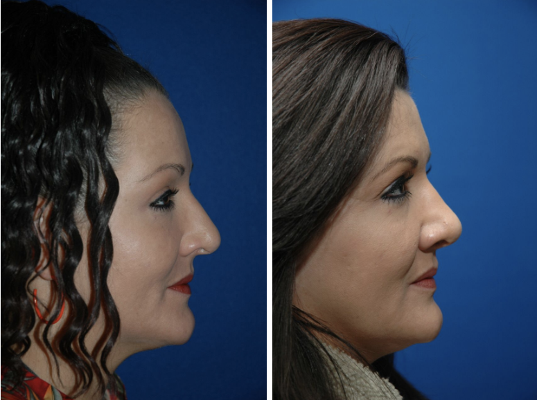 Nasal Reshaping Chadwell Facial Plastic Surgery Nose Job chadwell facial plastic surgery nose job
