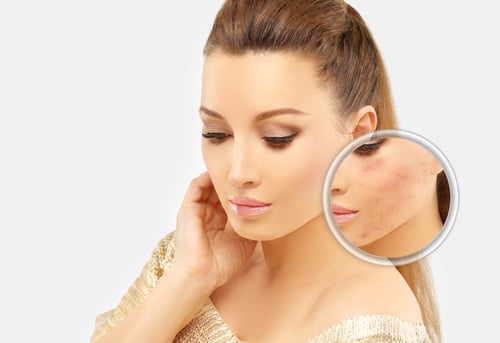 Have You Heard the Good News About Acne Scar Laser Surgery & IPL? 1 Acne Scary Laser Surgery