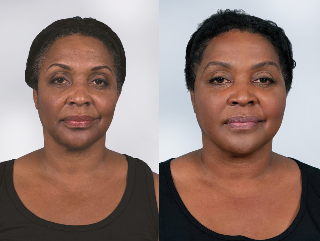 Non Surgical Gallery | Chadwell Facial Plastic Surgery