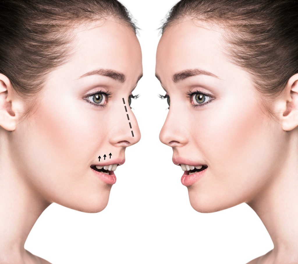 Nonsurgical Nose Job Chadwell Facial Plastic Surgery