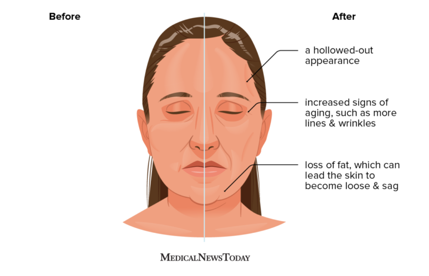 Ozempic Face Treatments To Restore Facial Volume