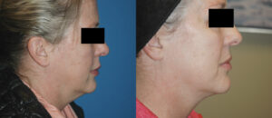 Before and after the Facetite photo